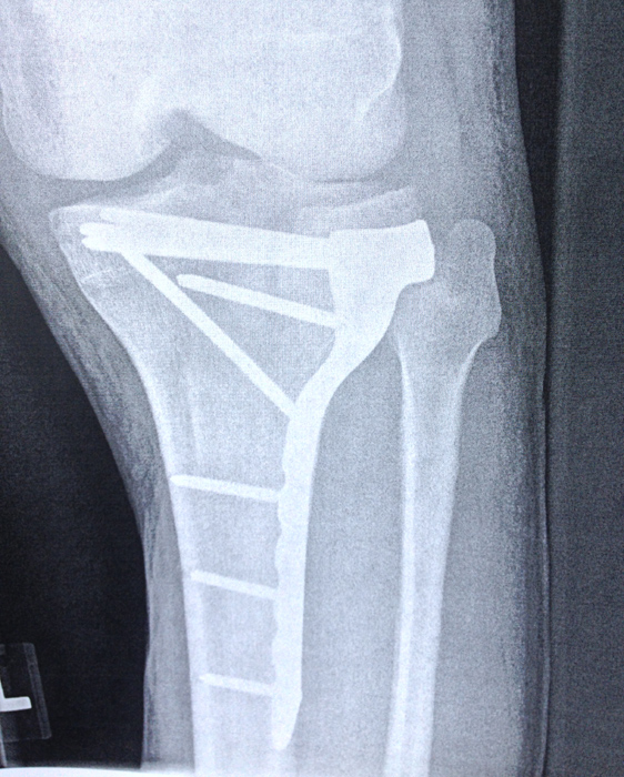 leg x-ray post tibial plateau surgery