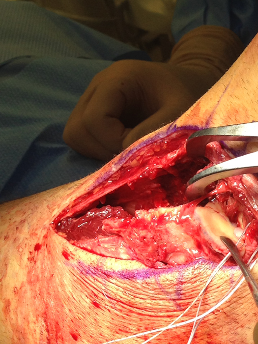 tibial plateau surgery